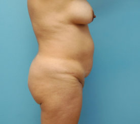 Κοιλιοπλαστική (Tummy Tuck)