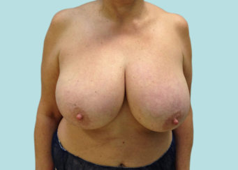 Μείωση μαστού, ανύψωση μαστού 