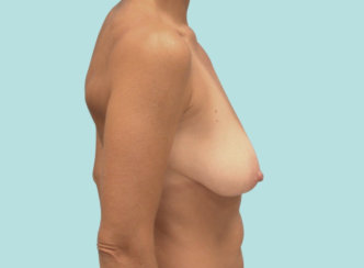 Ανύψωση μαστού, Μείωση μαστού