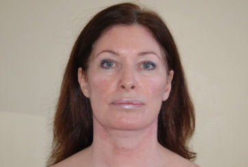 Facelift, Endoscopic Brow Lift & Endoscopic Forehead Lift