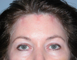 Facelift, Endoscopic Brow Lift & Endoscopic Forehead Lift