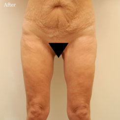 Medial Thigh Lift: Αντιμετώπιση του Χαλαρού Δέρματος του Εσωτερικού Μέρους των Μηρών και Δημιουργία «Κενού» Μεταξύ Μηρών