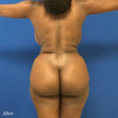 Liposuction of Abdomen and Lower Back