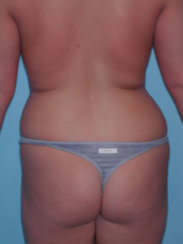 Λιποαναρρόφηση & Μοντέρνο Tummy Tuck