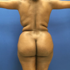 Liposuction of Abdomen and Lower Back