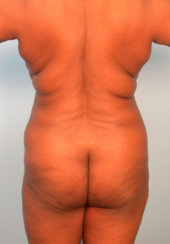 Liposuction of the Back