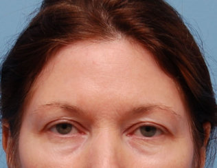 Facelift, Endoscopic Brow Lift & Endoscopic Forehead Lift