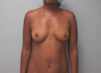 Breast Augmentation & Abdominal Liposuction