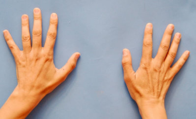 Αναζωογόνηση Χεριών: Μεταφορά Λίπους στα Χέρια