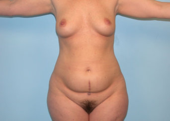 Μαμά Makeover: Σύγχρονη κοιλιοπλαστική και αύξηση στήθους