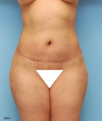 Μετασχηματισμός σώματος: Σύγχρονη κοιλιοπλαστική και βραζιλιάνικη ανύψωση, διόρθωση λακκούβας