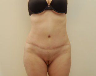 Κοιλιοπλαστική (Tummy Tuck)