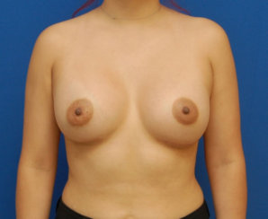 Αύξηση μαστού: Διόρθωση ασυμμετρίας μαστού
