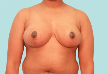 Μείωση μαστού, ανύψωση μαστού