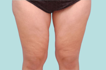 Medial Thigh Lift: Αντιμετώπιση της Χαλάρωσης του Δέρματος των Εσωτερικών Mηρών