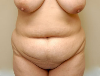 Tummy Tuck