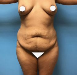 Κοιλιοπλαστική (Tummy Tuck)