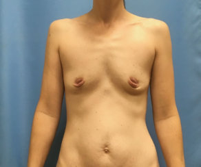 Διόρθωση Saggy στήθους με εμφυτεύματα & εσωτερική ανύψωση. Διόρθωση της ασυμμετρίας του μαστού. Διόρθωση των ανεστραμμένων θηλών