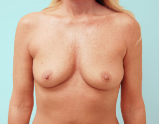 Αύξηση μαστού & διόρθωση ασυμμετρίας μαστού