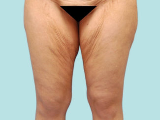 Medial Thigh Lift: Αντιμετώπιση της Χαλάρωσης του Δέρματος των Εσωτερικών Mηρών