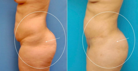 Μετασχηματισμός σώματος: Σύγχρονη κοιλιοπλαστική και βραζιλιάνικη ανύψωση, διόρθωση λακκούβας