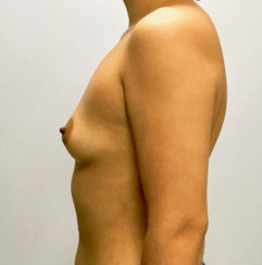 Αύξηση μαστού: Διόρθωση ασυμμετρίας μαστού