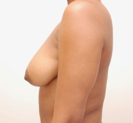 Ανύψωση μαστού, Μείωση μαστού