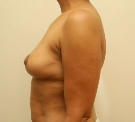 Μαμά Makeover: Breast Lift