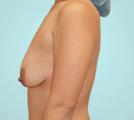 Αύξηση στήθους με ανύψωση στήθους ταυτόχρονα, Αύξηση & μαστοπυξία, κατακόρυφη ανύψωση, μαμά makeover