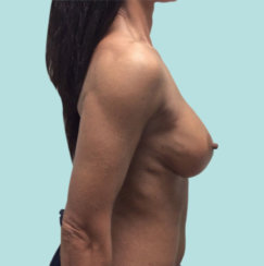 Αναθεώρηση εμφυτεύματος μαστού: Διόρθωση της δημιουργίας κυματισμού και διάσπασης εμφυτεύματος μαστού