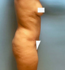 Κοιλιοπλαστική (Tummy Tuck)