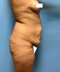 Κοιλιοπλαστική (Tummy Tuck)