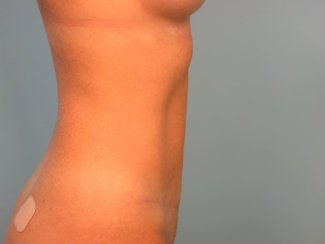 Tummy Tuck