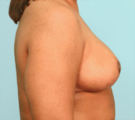 Μείωση μαστού, ανύψωση μαστού
