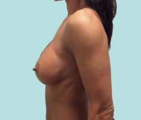 Αναθεώρηση εμφυτεύματος μαστού: Διόρθωση της δημιουργίας κυματισμού και διάσπασης εμφυτεύματος μαστού