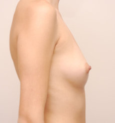 Αύξηση στήθους & διόρθωση ασυμμετρίας μαστού