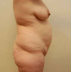 Μαμά Makeover: Σύγχρονη κοιλιοπλαστική, λιποαναρρόφηση και ανύψωση μαστού