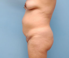 Κοιλιοπλαστική (Tummy Tuck)