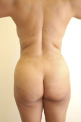 Liposuction of the Back