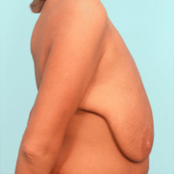 Αύξηση & μείωση στήθους μετά από μαζική απώλεια βάρους