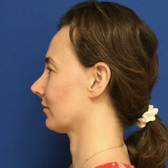 Minimally Invasive Midface Suspension (MIMS)-Ελάχιστα Επεμβατική Ανόρθωση Μέσης Επιφάνειας Προσώπου και Μεταφορά Λίπους στο Πρόσωπο