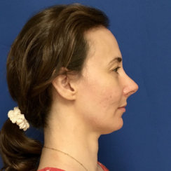 Minimally Invasive Midface Suspension (MIMS)-Ελάχιστα Επεμβατική Ανόρθωση Μέσης Επιφάνειας Προσώπου και Μεταφορά Λίπους στο Πρόσωπο