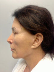 Ελάχιστα Eπεμβατικό Facelift