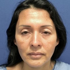 Upper Blepharoplasty & Eyelid Ptosis Correction