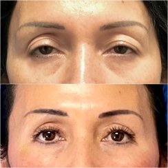 Upper Blepharoplasty & Eyelid Ptosis Correction