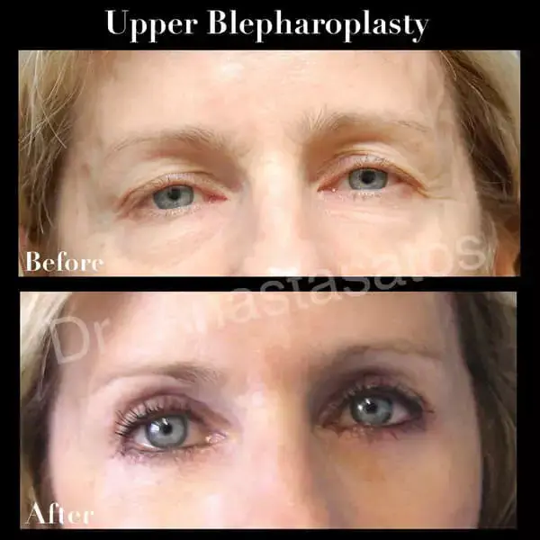 Photos of a woman's eyes before and after eyelid lifting