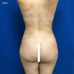 Liposuction 360