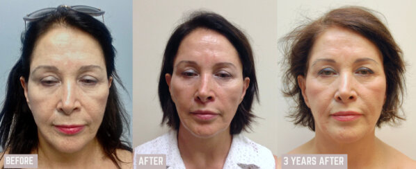 Minimally Invasive Midface Suspension (MIMS)-Ελάχιστα Επεμβατική Ανόρθωση Μέσης Επιφάνειας Προσώπου και Μεταφορά Λίπους στο Πρόσωπο