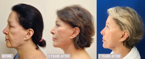 Minimally Invasive Midface Suspension (MIMS)-Ελάχιστα Επεμβατική Ανόρθωση Μέσης Επιφάνειας Προσώπου και Μεταφορά Λίπους στο Πρόσωπο