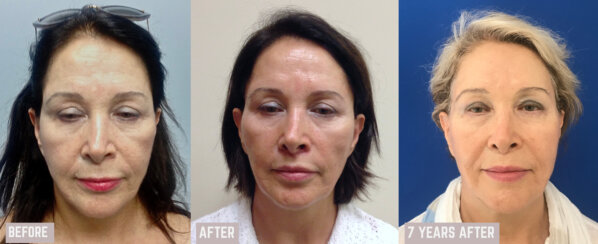 Minimally Invasive Midface Suspension (MIMS)-Ελάχιστα Επεμβατική Ανόρθωση Μέσης Επιφάνειας Προσώπου και Μεταφορά Λίπους στο Πρόσωπο